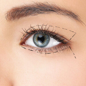 Blefaroplastia
